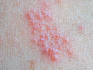 Shingles (Herpes Zoster, Shingles) is a type of skin disease. This is caused by the Varicella Zoster Virus,. Causes inflammation of the nerves burning pain and a rash along the nerves.