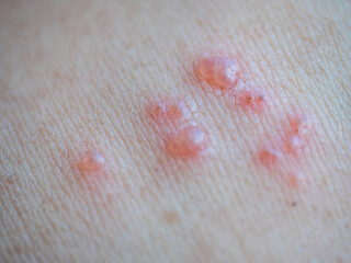 Shingles (Herpes Zoster, Shingles) is a type of skin disease. This is caused by the Varicella Zoster Virus,. Causes inflammation of the nerves burning pain and a rash along the nerves.