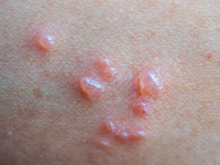 Shingles (Herpes Zoster, Shingles) is a type of skin disease. This is caused by the Varicella Zoster Virus,. Causes inflammation of the nerves burning pain and a rash along the nerves.