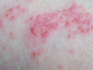 Shingles (Herpes Zoster, Shingles) is a type of skin disease. This is caused by the Varicella Zoster Virus,. Causes inflammation of the nerves burning pain and a rash along the nerves.
