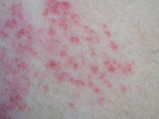 Shingles (Herpes Zoster, Shingles) is a type of skin disease. This is caused by the Varicella Zoster Virus,. Causes inflammation of the nerves burning pain and a rash along the nerves.