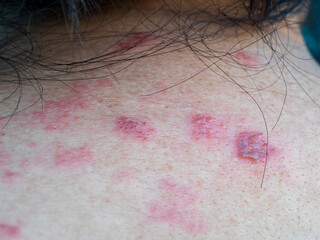 Shingles (Herpes Zoster, Shingles) is a type of skin disease. This is caused by the Varicella Zoster Virus,. Causes inflammation of the nerves burning pain and a rash along the nerves.