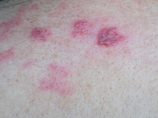 Shingles (Herpes Zoster, Shingles) is a type of skin disease. This is caused by the Varicella Zoster Virus,. Causes inflammation of the nerves burning pain and a rash along the nerves.