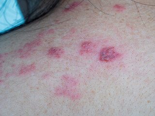 Shingles (Herpes Zoster, Shingles) is a type of skin disease. This is caused by the Varicella Zoster Virus,. Causes inflammation of the nerves burning pain and a rash along the nerves.