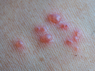 Shingles (Herpes Zoster, Shingles) is a type of skin disease. This is caused by the Varicella Zoster Virus,. Causes inflammation of the nerves burning pain and a rash along the nerves.