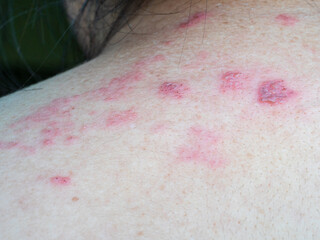 Shingles (Herpes Zoster, Shingles) is a type of skin disease. This is caused by the Varicella Zoster Virus,. Causes inflammation of the nerves burning pain and a rash along the nerves.