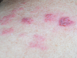 Shingles (Herpes Zoster, Shingles) is a type of skin disease. This is caused by the Varicella Zoster Virus,. Causes inflammation of the nerves burning pain and a rash along the nerves.