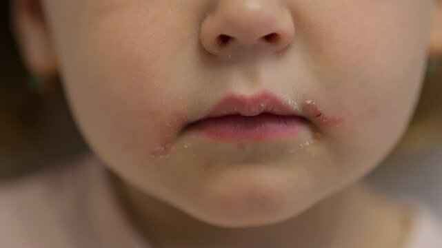 Child showing symptoms of hand foot and mouth disease