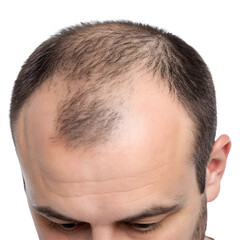 Obraz premium Close-Up of Thinning Hair and Bald Spots