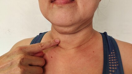 Portrait the fingers holding the flabbiness adipose sagging skin, double layer on the neck, wattle and cellulite under the chin, Flabby skin and loose on the body, health care and beauty concept.