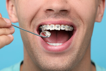 Fototapeta premium Examination of man's teeth with braces using mirror tool on light blue background, closeup