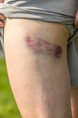 big bruise on the mens leg skin close up