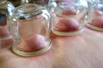 Close-up of Cupping Therapy suction cups. The skin is sucked into the suction cup and is particularly red.