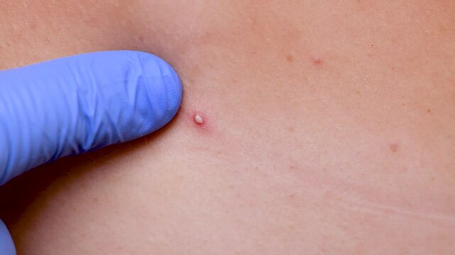 Young girl shows pimples on her skin on her back and shoulders. Beautician removes pimples on her skin