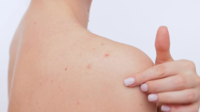Young girl shows pimples on her skin on her back and shoulders.