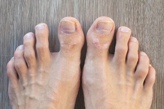 close up of male feet, fungus, calluses and nail diseases, treatment, health and hygiene concept