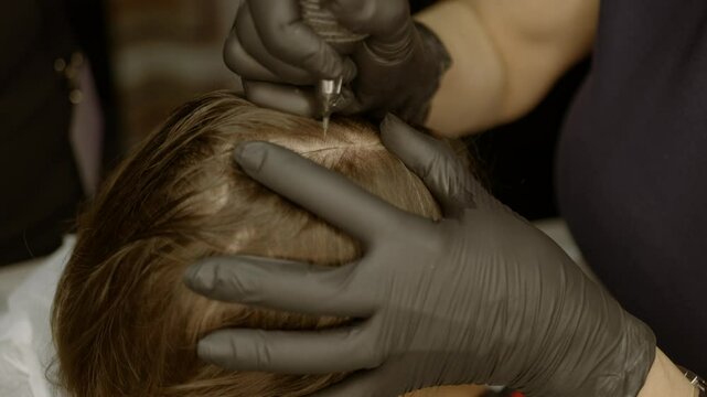 Close up shots of Scalp micropigmentation, also known as a hair tattoo, can cover bald spots or thinning hair without surgery