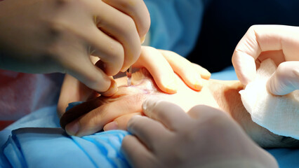 Surgeon demonstrates precision and expertise while performing a delicate hand surgery with...