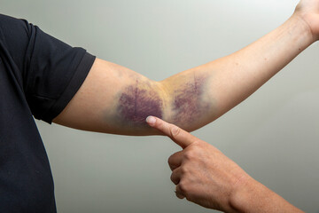 A bruise on an arm is being pointed at.