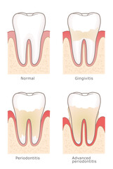 Gum inflammation stages gingivitis and periodontitis. Four stages of human gum inflammation development, vector illustration.