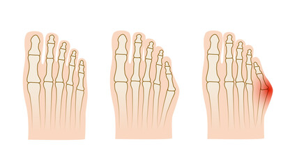 Taylor deformation. Valgus deformity of the little toe joint. Vector illustration.