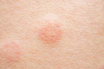 Naklejka premium Skin allergy rash dermatitis texture close up background