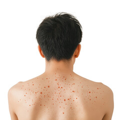 Naklejka premium A person’s back displaying numerous small red spots, indicating skin conditions or irritation., isolated on a transparent background.