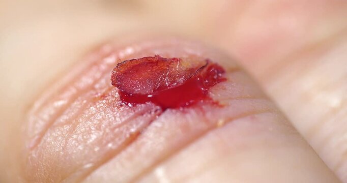Injury to middle finger of right hand with bleeding. Flayed skin, red blood and lymphatic fluid flows from wound