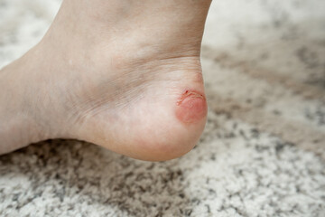 Close-up callus on a woman's ankle caused by wearing the wrong shoes