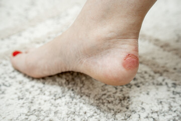 Close-up callus on a woman's ankle caused by wearing the wrong shoes