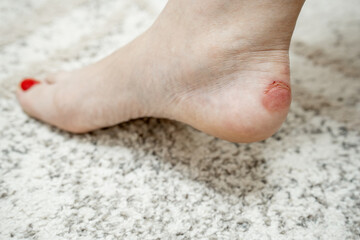 Close-up callus on a woman's ankle caused by wearing the wrong shoes