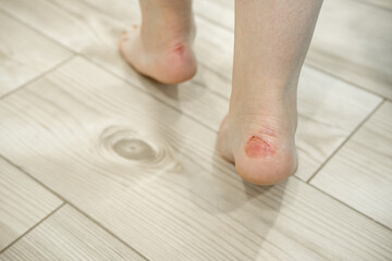 Callus on the foot.  A wound on the leg from a callus.