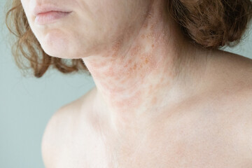 View of a young woman's neck. Atopic dermatitis. Eczema. Skin condition.