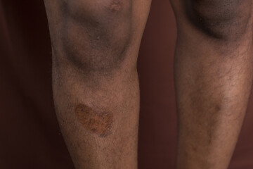 Naklejka premium Scarred skin on the shin, scarring from injury beneath the knee, damaged skin from injury on brown skin