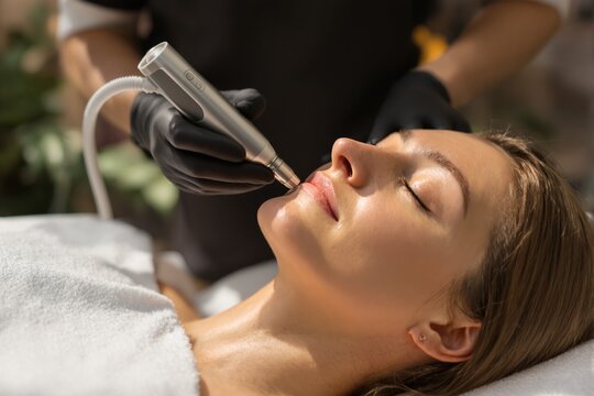 Close-Up of Microneedling Procedure on Woman's Face in Spa Setting