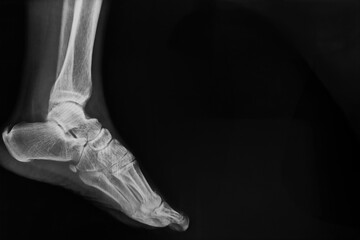 Black and white X-ray film of the foot bones.