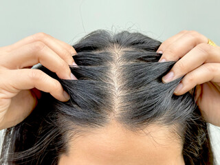 Fototapeta premium Women with hair loss dryness and frizziness