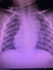 Film x-ray show situs solitude dextrocardia the apex of the heart is located on the right side of the body congenital heart disease medical and technology concept 