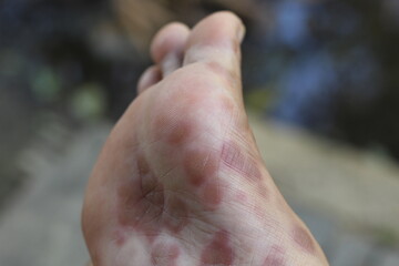 inflamed, peeling and damaged foot skin due to R-CHOPP chemotherapy treatment