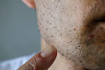 Fototapeta premium レーザー脱毛直後の日本人男性の肌