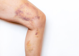 Fototapeta premium Removal of varicose veins on the leg. Postoperative bruises and scars on the leg after removal of a varicose vein.