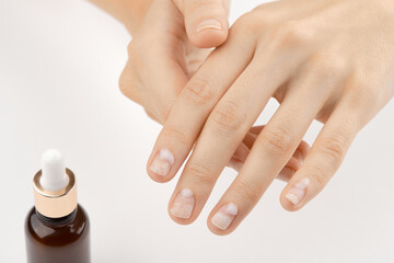 Woman applying medicine to damaged nails. Fingernails with onycholysis after removing gel polish