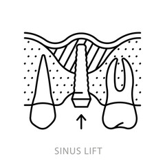 Sinus lift, icon. Sinus lift with dental implant. Linear illustration of procedure to provide sufficient bone and replacement tooth. Dentistry and teeth restoration topic. Editable stroke icon