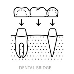 Dental bridge, line icon. Installation scheme and anatomy of artificial teeth. Dentistry and teeth restoration topic. Linear illustration, editable stroke icon