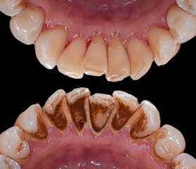 teeth tartar and calculus cleaning 