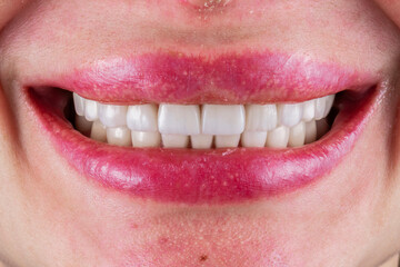 ceramic emax crowns and veneers