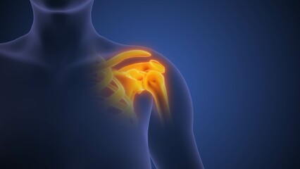 Medical concept of the human shoulder pain syndrome animation