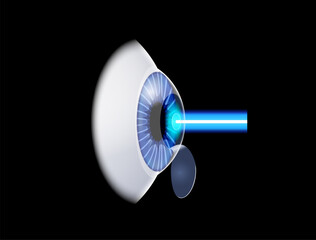 LASIK eye surgery