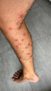 Bright red marks from insect bites on male human legs. Cercaria bite
