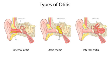 otitis ear infections external otitis, otitis media, and internal otitis with inflammation and pus buildup diagram hand drawn schematic vector illustration. Medical science educational illustration